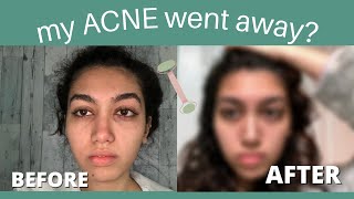 I Tried Rose Quartz Roller for a Week for Acne // BEFORE AND AFTER RESULTS // jade roller & gua sha