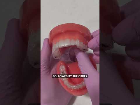 How to Insert and Remove Your Aligners | Helix House Orthodontics