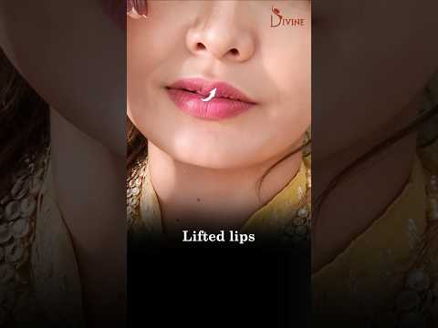 Enhance Your Smile: Achieve a Youthful Look with a Lip Lift! Lift Lip Result #ytshorts