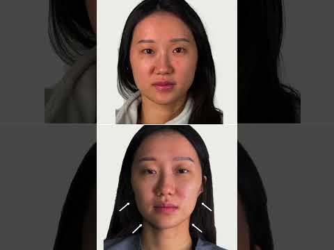 Full face transformation with injectables (sculpt+Lift) ! #injectables #filler #toronto #botox