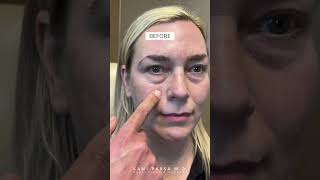 4 Months After Quadfecta Lift with Dr. Kami Parsa | Upper and Lower Blepharoplasty