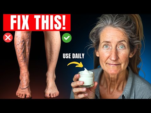 "20 YEARS LEG PAIN GONE!!" Varicose Veins Treatment That ACTUALLY Works! | Barbara O'Neill