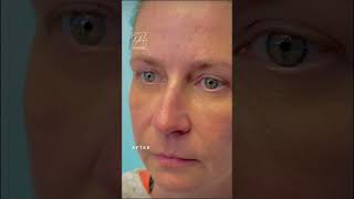 Brow Lift and Blepharoplasty #shorts #eyebrows #eyesrejuvenation