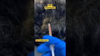 Hair Loss Treatment #hair #hairloss #hairlosstreatment #ytshorts #alopecia #hairtransplant #hairfall