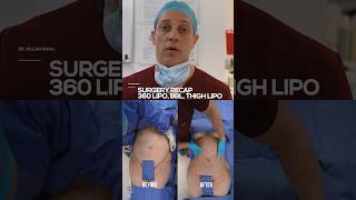 360 Lipo & BBL Results You Won’t Believe | Stunning Before & After!