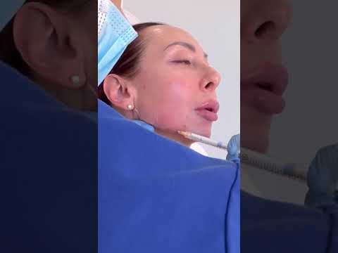#torontoinjectables #sculptandlift #nonsurgicallift #avebelle