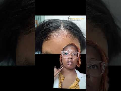 #contactdermatitis and why it's important what you put on your #scalp and #hair #miracledrop #bbjudy