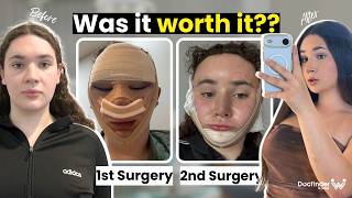 My Second Surgery in Korea - Was It Worth It?! (FFS in South Korea)