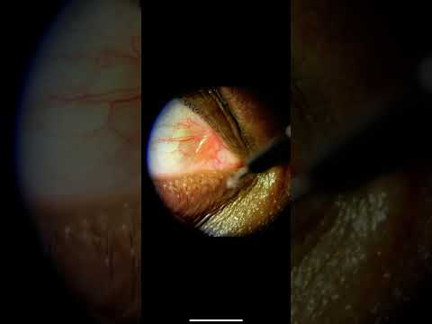 Punctual Plugs for Dry Eye Disease