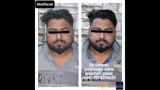 #face #cosmetic #skincare #medifacial #detanfacial #detan #skincaretips #skincareroutine #carbonpeel
