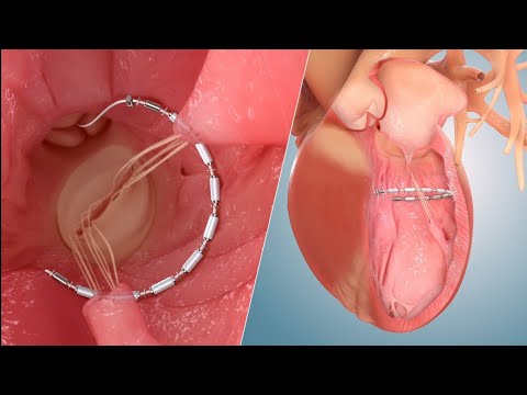 AccuCinch implant ( Animation Video ) #cardiology