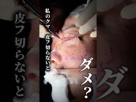 【クマ治療】皮膚の余りは切開系クマ治療で治療#クマ取り #クマ改善 #美容整形 #shorts