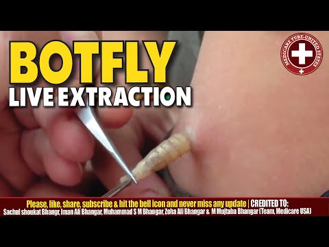 Live Botfly Larvae Extraction | Removal Process Caught on Camera.