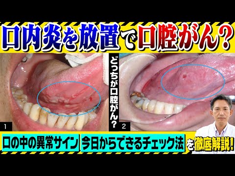 それはただの口内炎じゃないかも！？正体は口腔がん！？