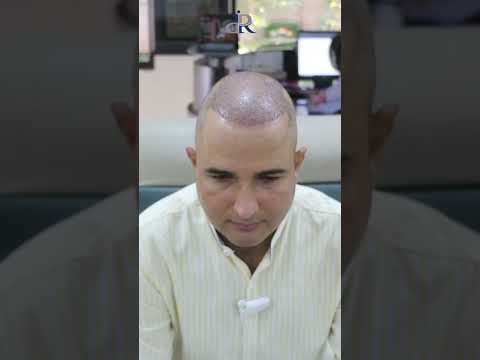 10 Months FUE Hair Transplant Results by Dr Rana Irfan !#drranairfan #hairtransplant #fyp #shorts