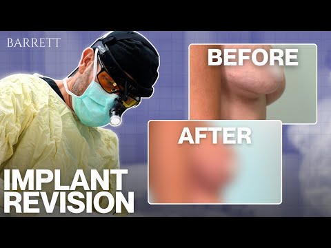 Complex Implant Revision Surgery | Stunning Transformation!