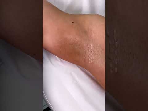 Botox to treat excessive underarm sweating 💦