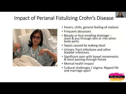 Crohn’s Perianal Fistulas: Better Together! A team approach to patient care