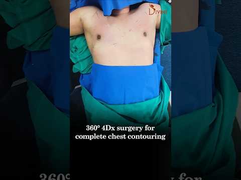 Gynecomastia Surgery Before and After | On Table Result #shortfeed