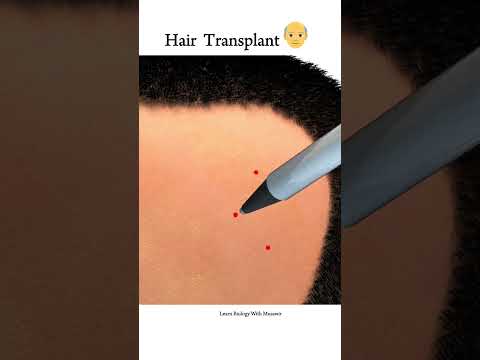 Hair transplant surgery animation short video