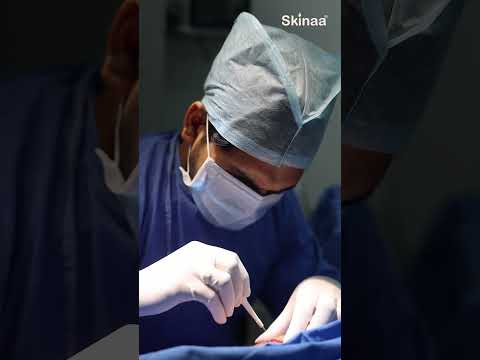 Best Treatment of Vitiligo or White Patches with Vitiligo Surgery at Skinaa #viral #shortsviral