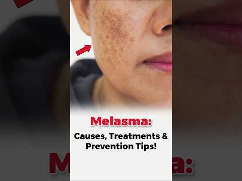 Melasma: Causes, Treatments & Prevention Tips!