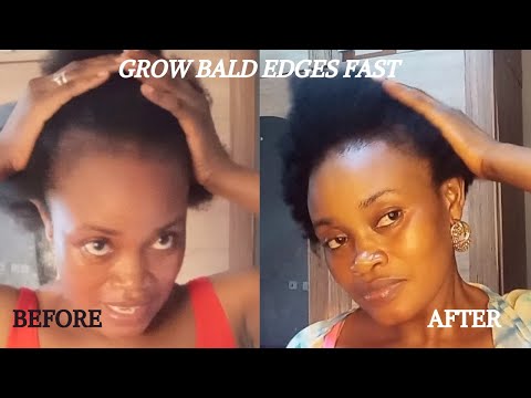 HOW TO TREAT YOUR BALDNESS & THIN EDGES FAST // THIS TREATMENT WILL GROW YOUR HAIR FAST IN 1 MONTH