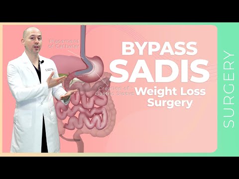 BYPASS SADIS What is it? How it works? | Surgery