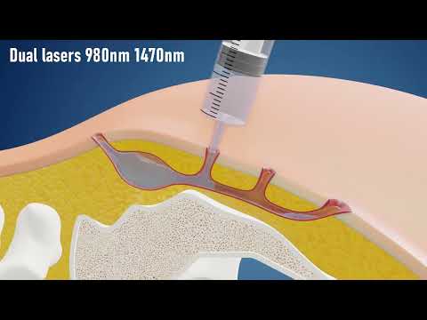 Sinus Laser Ablation Of Pilonidal Cyst SILAC - IBI Healthcare Institute