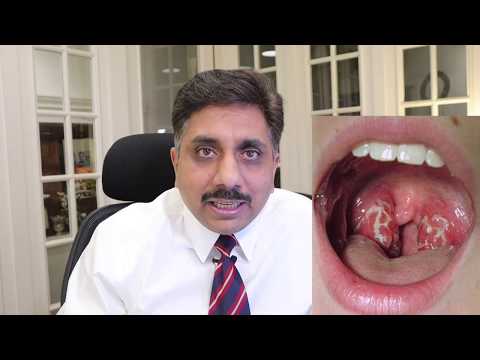 Homeopathic Medicines for Tonsillitis