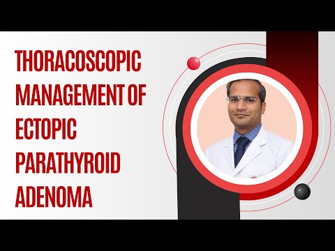 Thoracoscopic Management of Ectopic Parathyroid Adenoma – At WALS 2025 by Dr. Piyush Kumar Aggarwal