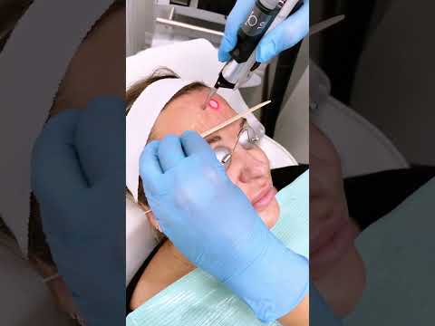 Laser treatment for broken capillaries redness and flushing!