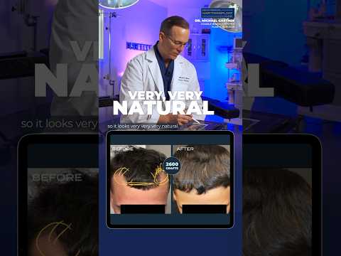 💫Watch Dr. Gartner's Latest Hair Transplant Case / #hairregrowth #hairtransplantresults