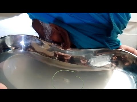 Old Man Feeling Good After Removing Significant Amount Of Soft Wax / ASMR Part 2/#earwax #waxremoval
