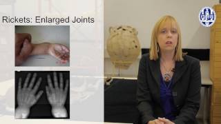 2.4 Paleopathology Rickets