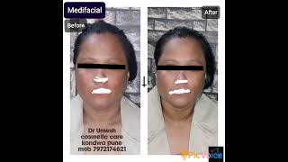 #face #skincare #cosmetic #detanfacial #detanning #detan #skinglow #skinhealth #skinbrightening