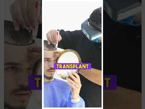 Right Age for Hair Transplant Surgery ? #drranairfan #hairtransplant #hairloss #shorts #fyp