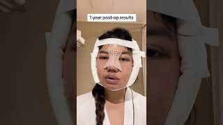 1 YEAR PLASTIC SURGERY POST-OP RESULTS😱😱😱 #plasticsurgeryinkorea #beforeandafter #transformation