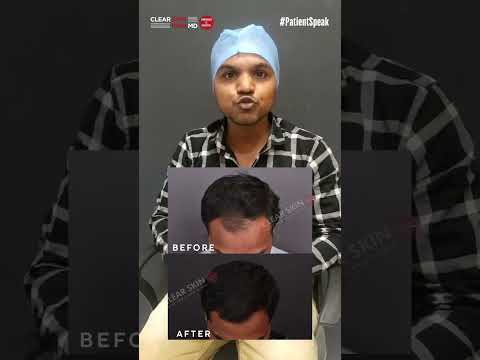 How to Stop Hair Loss Effectively: Real Patient Results Revealed! | HairMD, Pune