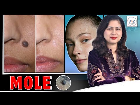 Mole Removal Treatment in Jammu | Types, Causes & Safe Procedures by Dr. Cheena Langer