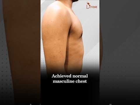 Gynecomastia | No More Hiding! Get a Sculpted Chest with 4Dx Surgery!