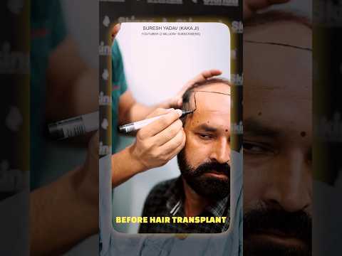 Hair Transplant Review of a Happy Patient at Skinaa Clinic! #viralshorts