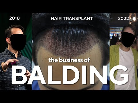 The Dreadful Business of Balding & Hair Loss
