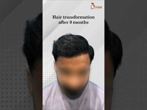 Secret Hair Restoration: No Shave, Natural Results in Just 3 Days!