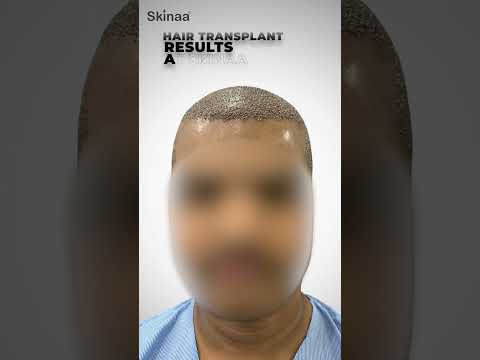 Hair Transplant at Skinaa Clinic Jaipur | Amazing Before & After Results #viral #shortsviral