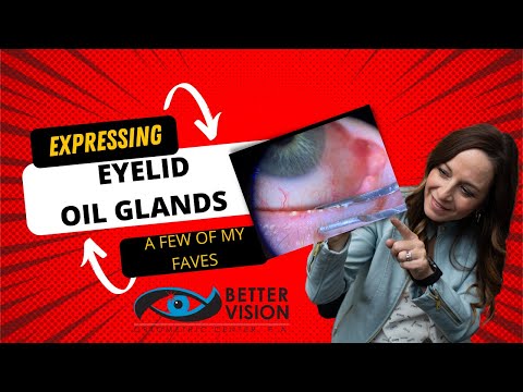 Meibomian Gland Expression