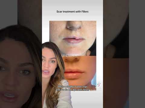Scar improvement using dermal filler injection. #scartreatment #acnescarremoval #avebelle