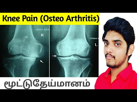 Osteoarthritis(Knee Pain) home remedies-Tamil. Ask Dr Ajith. Medical Advice.