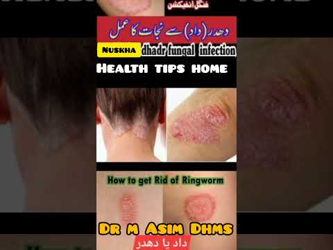 دھدر ( داد ) سے نجات  || Health tips home