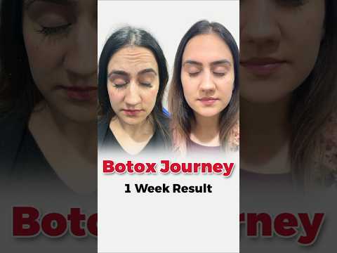 BOTOX Journey: 1 Week Later & Loving the Natural Results!